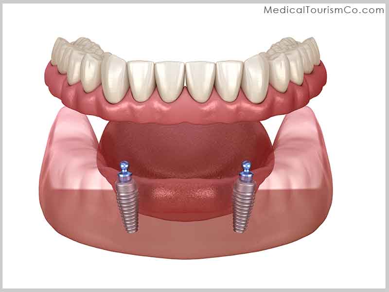 Snap in Dentures