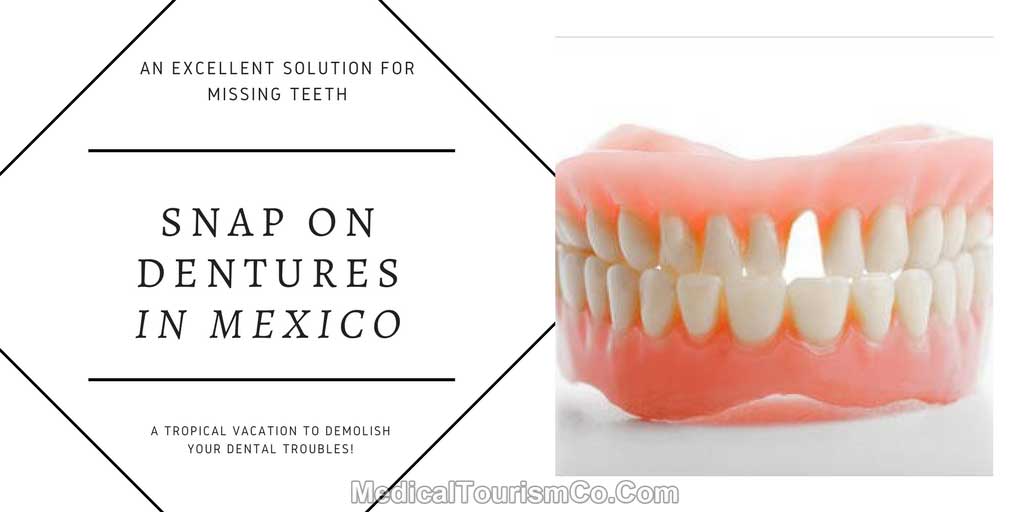 Snap-On-Dentures-in-mexico.jpg