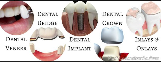 Full Mouth Restoration Procedures Cancun