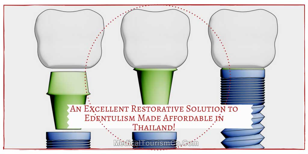 An-Excellent-Restorative-Solution-to-Endentulism-Made-Affordable-in-Thailand-1.jpg