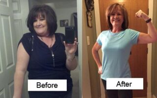 Bariatric - Before and After