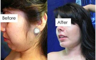 Before and After Plastic Surgery in Mexico