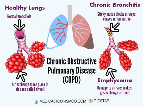 COPD