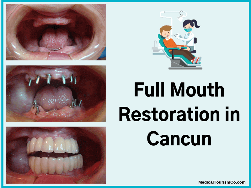 Full-Mouth-Restoration-in-Cancun-1-1-1-1-1-1.png