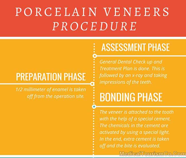 Dental Veneers Procedure