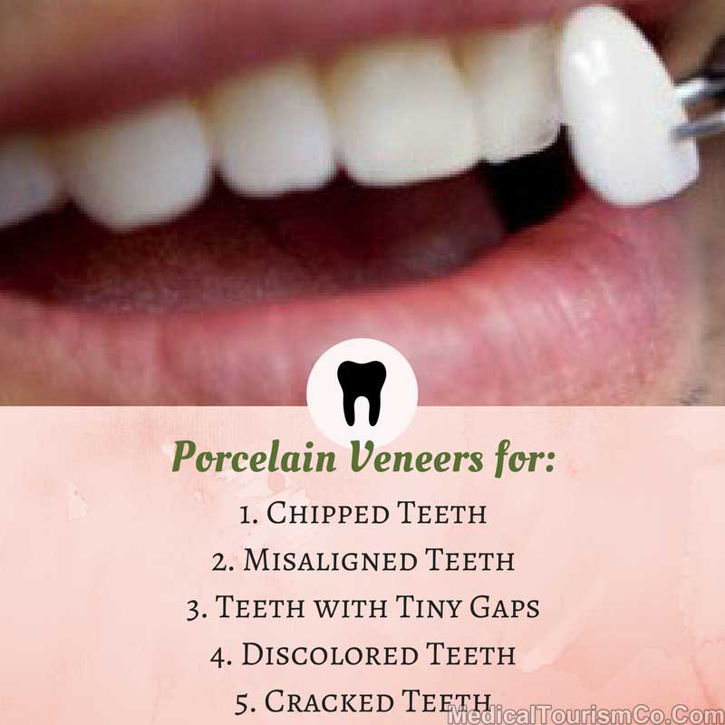 Why Porcelain Veneers