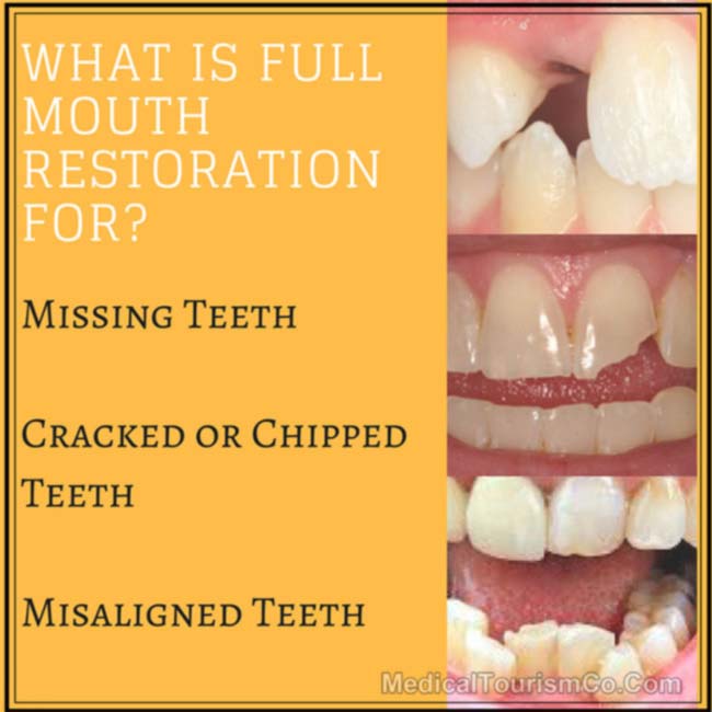 Why Full-mouth-restoration-for_-1