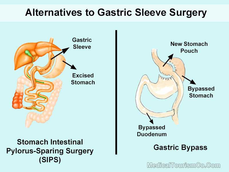 Alternatives to Gastric Sleeve