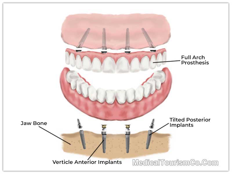 All on 4 Dental Implant Tijuana