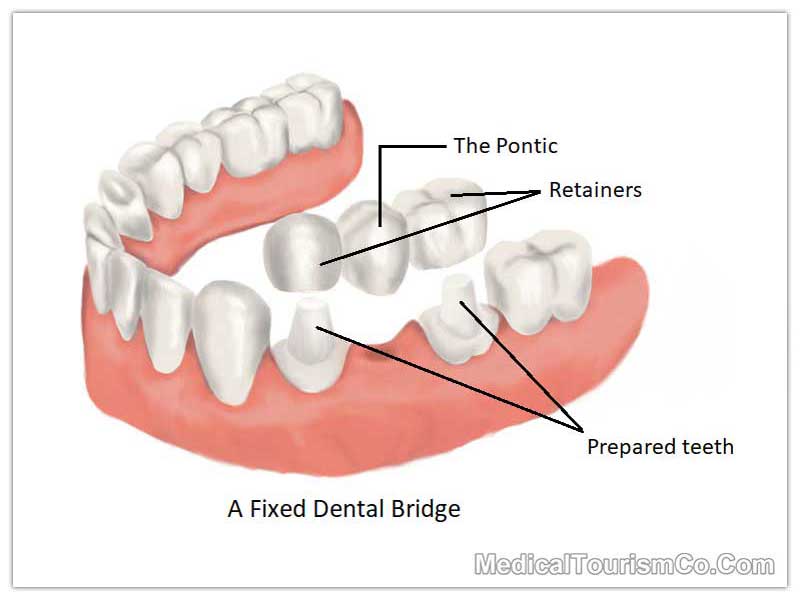 Dental Bridge Mexico