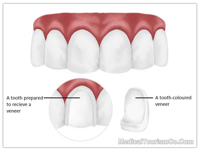 Dental Veneers Cambodia