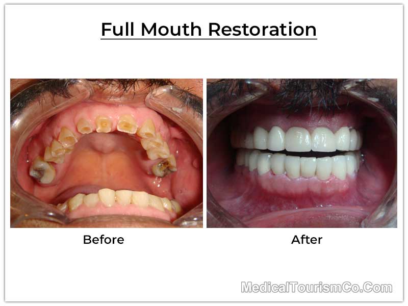 Full Mouth Restoration