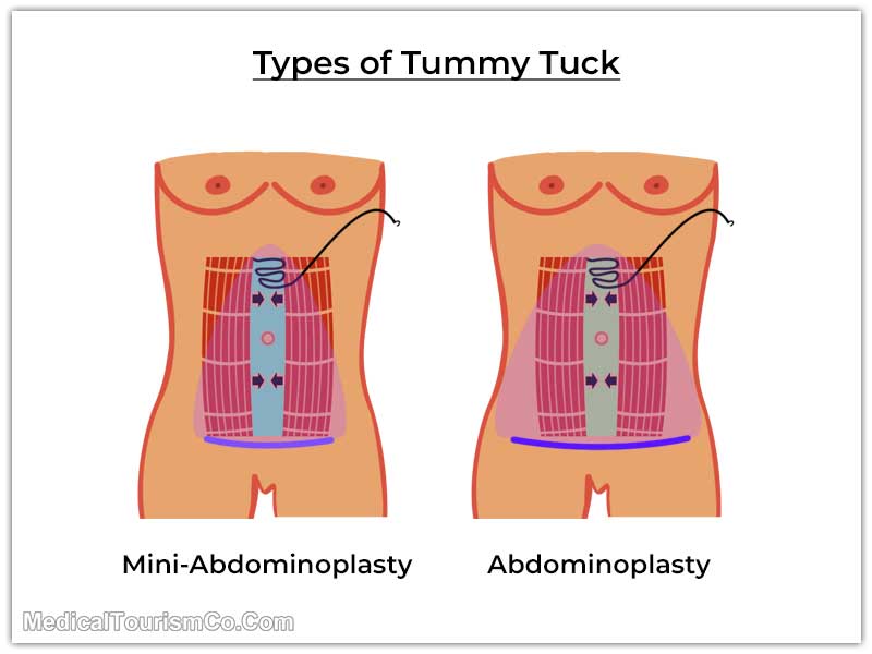 Mini and Normal Abdominoplasty