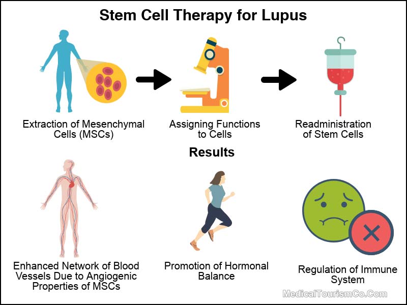 Stem Cell Therapy for Lupus in Mexico Infographic