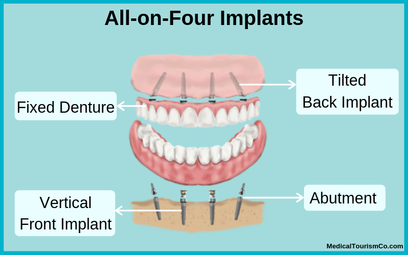 All-on-4 implants in Cambodia