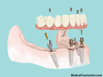 Hybrid denture on All-on-4