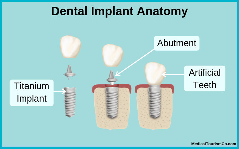 Dental Implant in Barranquilla