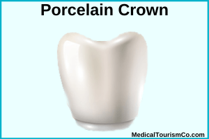 Porcelain crowns in Chandigarh