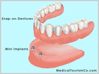 Snap-on-Dentures Cost Abroad