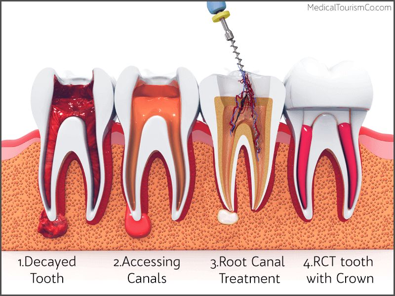 Root Canal Treatment Barranquilla