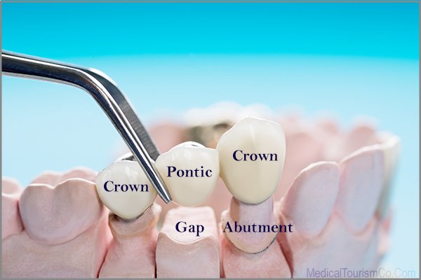 Dental Bridge Cost-Fixed Denture Abroad