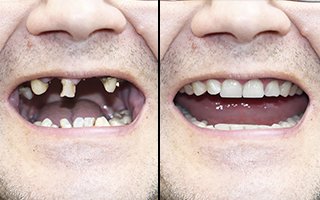 Before & After Dental Implants