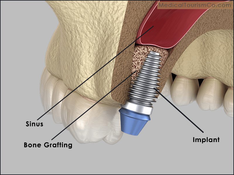 Sinus Lift in Ahmedabad