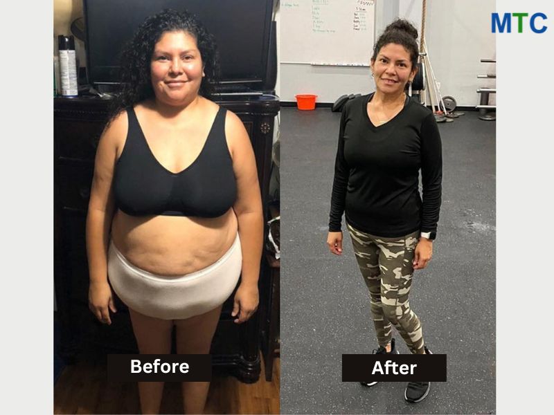 Bariatric Surgery Before and After