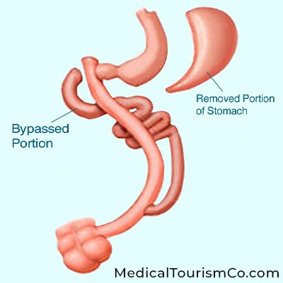 Duodenal Switch Surgery in Mexicali