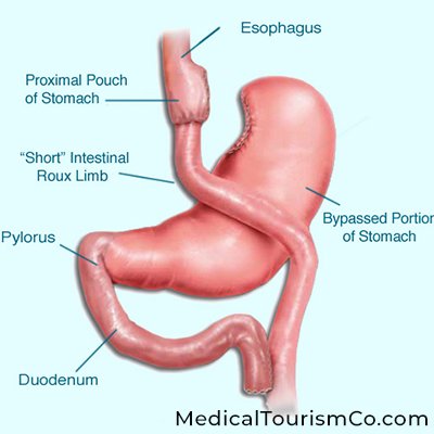 Gastric Bypass in Mexicali, Mexico