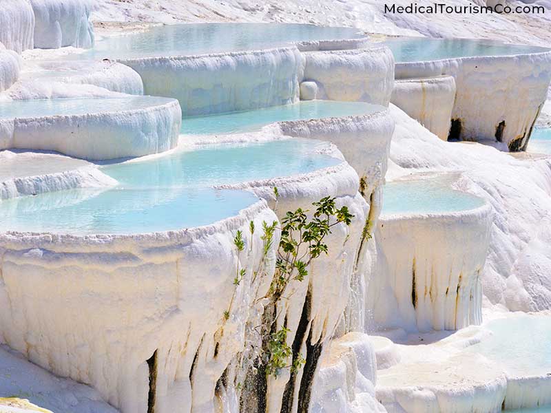 Hierapolis Pamukkale | Dental tourism in Turkey