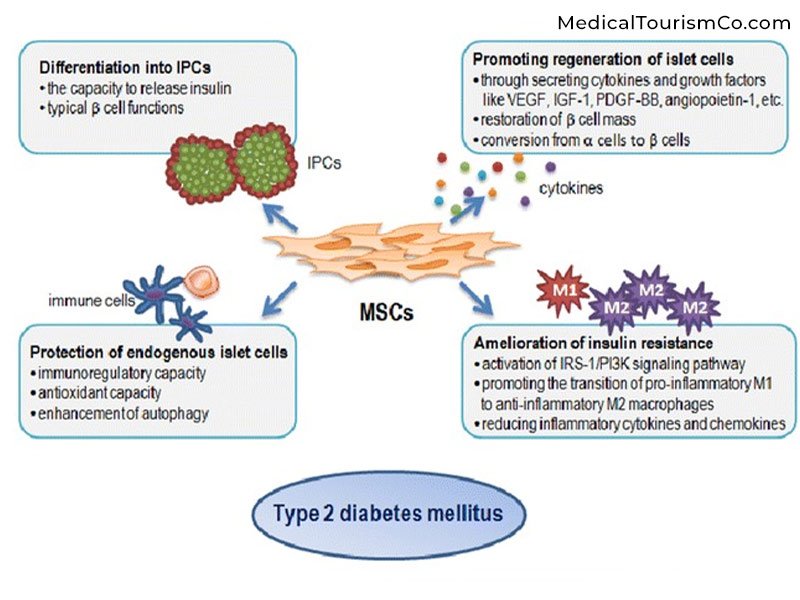 Why Stem Cell for Diabetes Type-2?