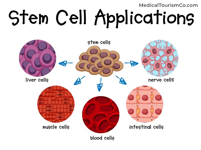 Stem Cells for Diabetes in India