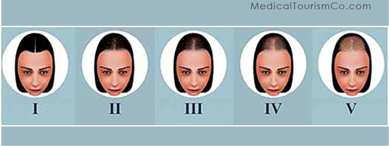 Stem Cell for Hair Loss: Female Pattern Hair Loss