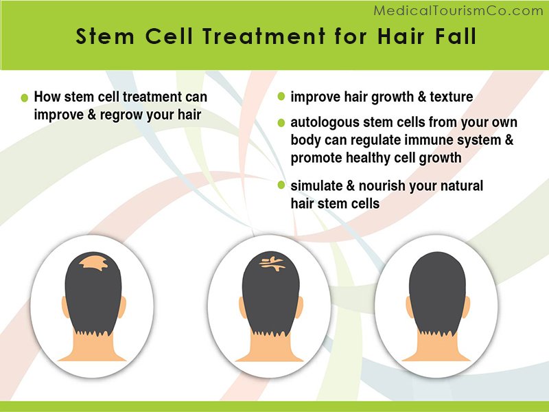 Stem Cell Treatment for Hair Loss in India