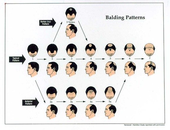 Stem Cell for Hair Loss: Male Pattern Hair Loss