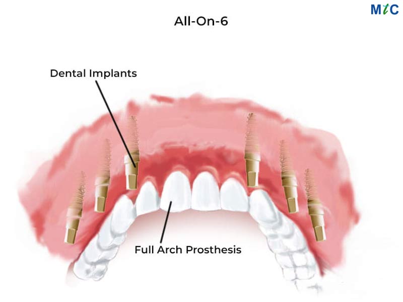 All-on-6 Dental Implants