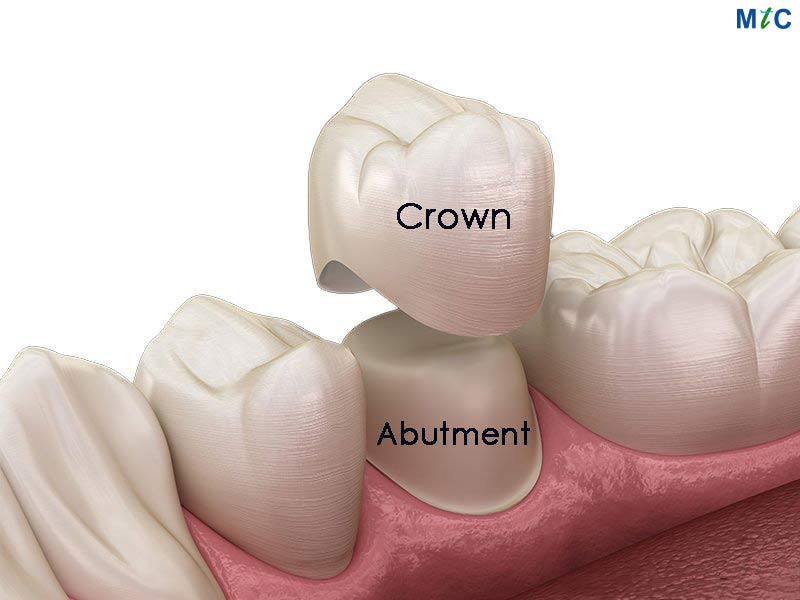 Dental Crowns in Los Algodones