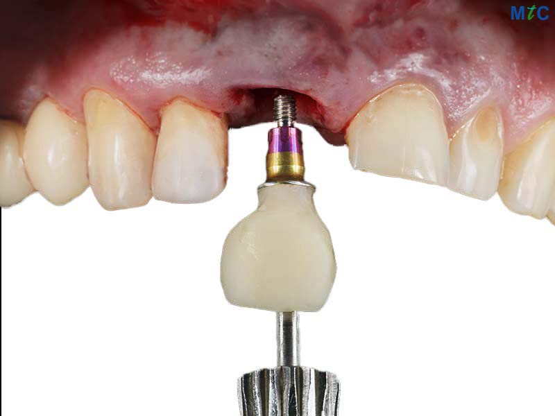 Dental Implants in Los Algodones