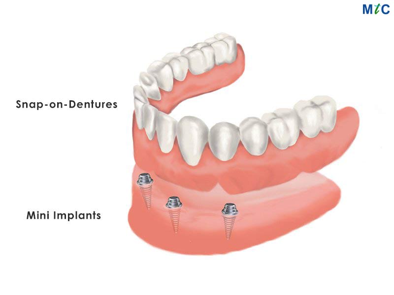 Snap-on-Denture in Los Algodones