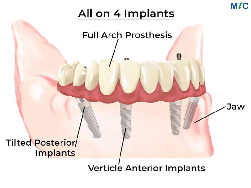 All on 4 Dental Implants