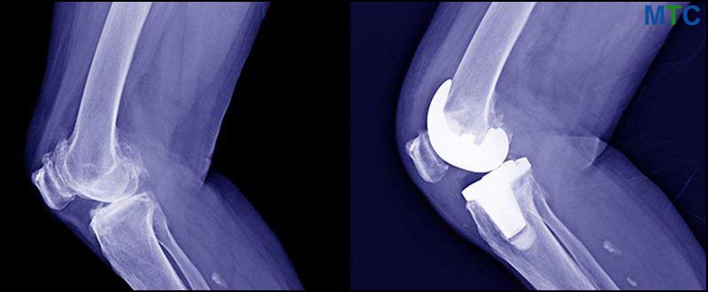 TKR X-Ray