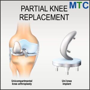 Partial knee replacement