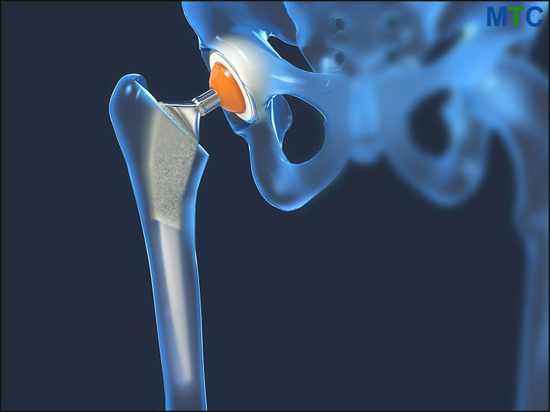 hip-implant (1)