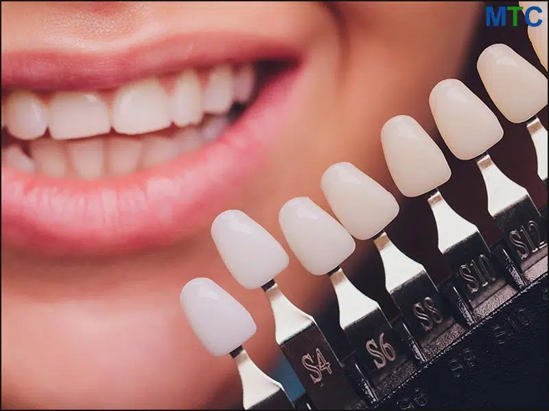 Dental veneers in Cancun