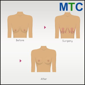 Breast Augmentation in Spain