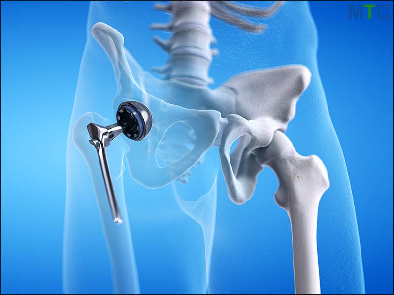 Hip Replacement in Puebla, Mexico