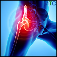 Lateral Approach to hip replacement