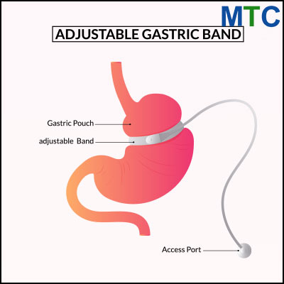 Gastric Band