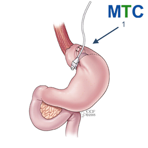 Gastric Band